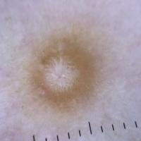 Dermoscopic appearance of upper lesion from…