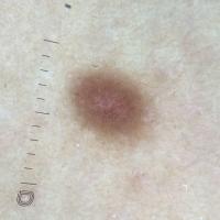 Flat dermatofibromaThe predominant feature is a…