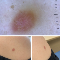 A flat dermatofibomaClinically pinch/dimple…