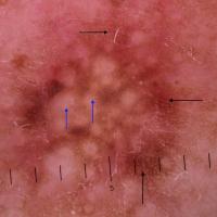 Dermoscopic appearance of previous figure&nbsp;A…