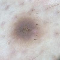 DermatofibromaThis represents one of the least…