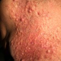 Dermatofibrosarcoma protuberans
Copied with kind…