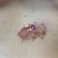 Dermatofibrosarcoma protuberans
Copied with kind…