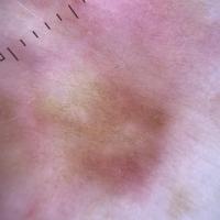 Dermoscopic image of previous figure
Copied with…