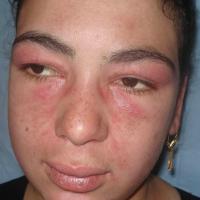 
	Dermatomyositis and&nbsp;heliotrope…