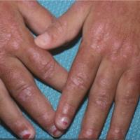 
	Dermatomyositis and Gottron's papules