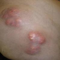 Dermatomyositis and calcinosis