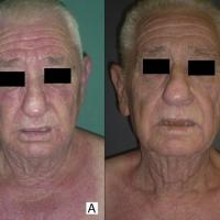 
	Dermatomyositis secondary to bladder…
