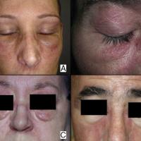 
	Dermatomyositis

	Heliotrope rash and oedema