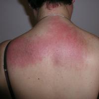 
	Dermatomyositis