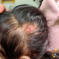 Dermoid cyst
Copied with kind permission from…