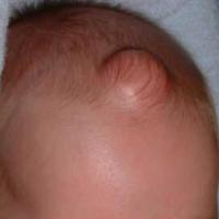 
	Dermoid cyst affecting the anterior fontanelle
