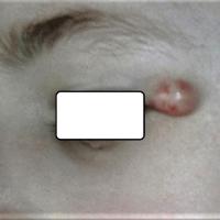 Dermoid cyst