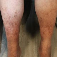
	Diabetic dermopathy