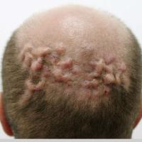 Dissecting cellulitis 