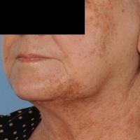 
	Same patient as figure 6