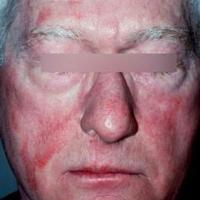 Photodermatosis: drug-induced
Relative sparing…