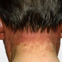 
	Photodermatosis: drug-induced

	Note the…