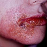 
	CAD: anti-herpetic treatment
	
	Copied with…