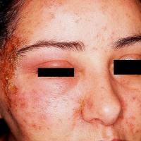 
	CAD: Paraphenylenediamine (PPD) in black hair…