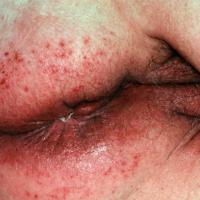 
	CAD: &nbsp;Benzocaine cream, used to treat…