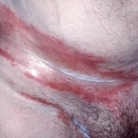 
	CAD: Neomycin cream