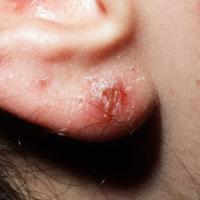 
	Contact allergic dermatitis: nickel in earrings