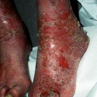 
	CAD: a topical antibiotic / steroid preparation…