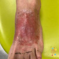 Contact allergic dermatitis&nbsp;
Copied with…