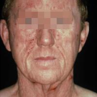 
	Airbourne contact dermatitis to sesquiterpene…