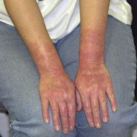 
	Latex allergy (contact urticaria)

	Erythema…