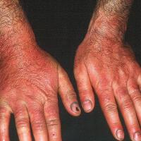 
	CAD: thiuram in rubber gloves
	
	Copied with…