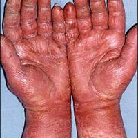 
	Latex allergy (contact urticaria)

	A more…