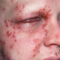 Eczema herpeticum with ocular involvement&nbsp;