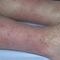 
	Same patient as previous figure: close-up