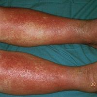 
	Gravitational eczema

	Both legs affected