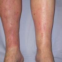 
	Gravitational eczema

	Itch, non-tender…
