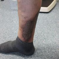 
	Gravitational eczema - same patient as…