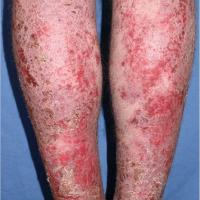 Gravitational eczema
Copied with kind permission…