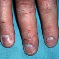 
	Hand eczema - part of atopic eczema
