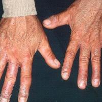 
	Contact allergic dermatitis to chromate in…
