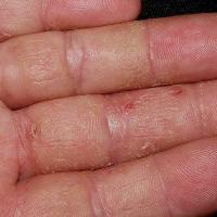 
	Contact irritant dermatitis

	Copied with kind…