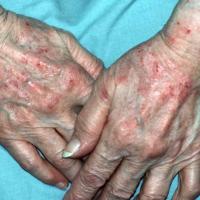 
	Hand eczema