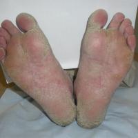 
	Hyperkeratotic eczema on the feet