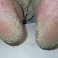 
	Hyperkeratotic eczema on the feet