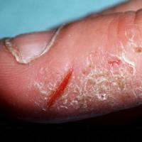 
	Hand eczema with fissures
