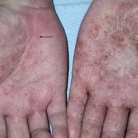 
	Pompholyx eczema

	Multiple clear vesicles…