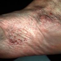 
	Pompholyx affecting the feet