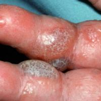 
	Pompholyx

	Large blisters