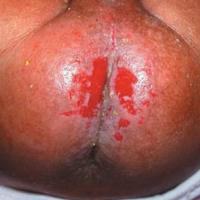 
	Ammoniacal dermatitis

	Ulceration present